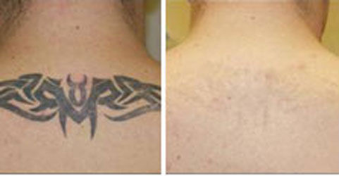 Как безопасно и эффективно свести татуировку? Отвечает специалист | BURO.